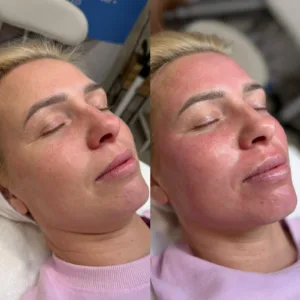 Microneedling Oradea