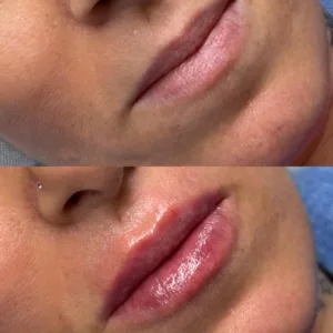 Buze Acid Hialuronic Oradea Nora Pop Pret 2026
