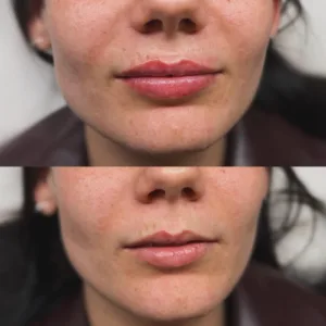Buze cu Hyaluron Pen Oradea Buze Acid Hialuronic Oradea Nora Pop